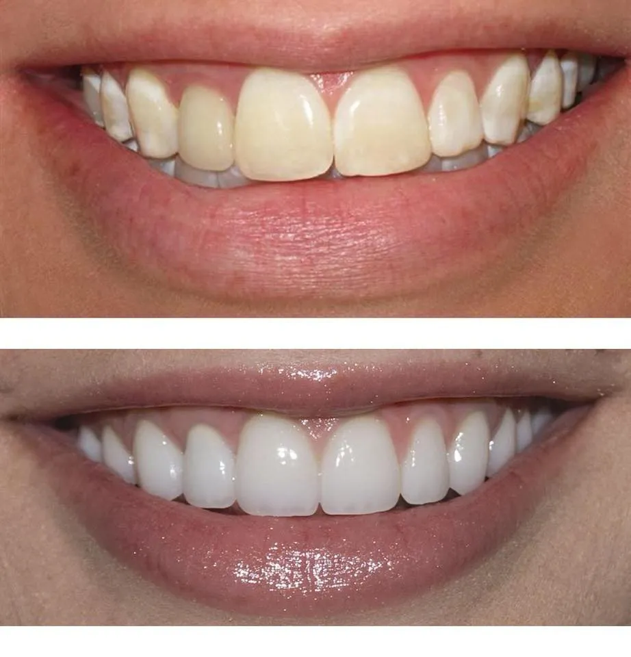 26128 laser teeth whitening procedure