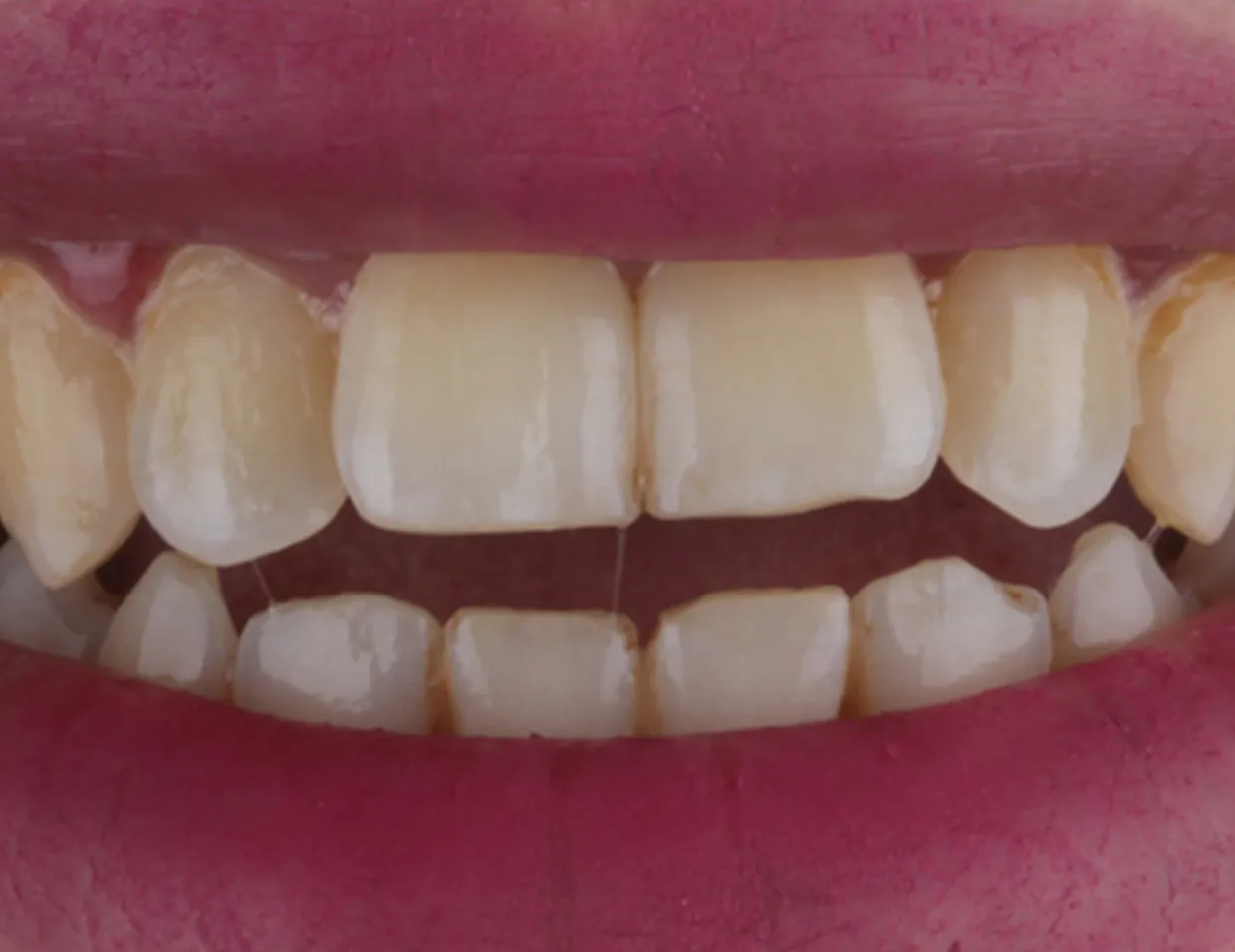 26129 alternative teeth whitening