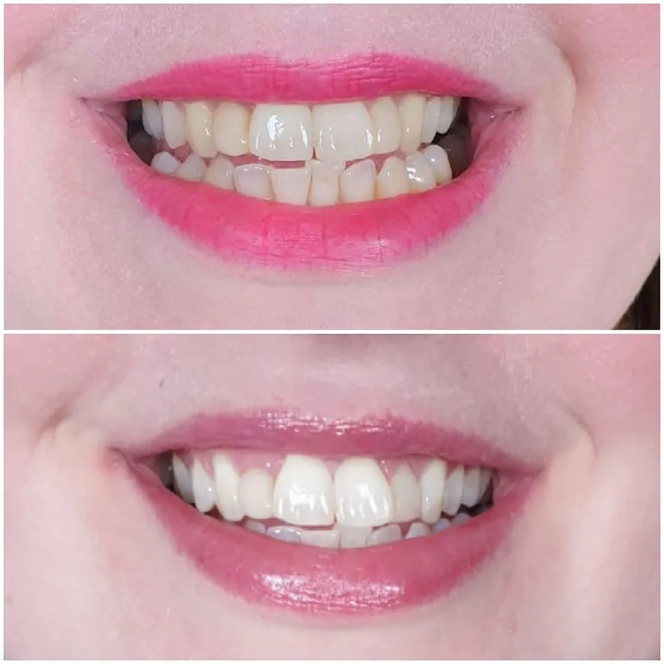 26129 gum irritation teeth whitening