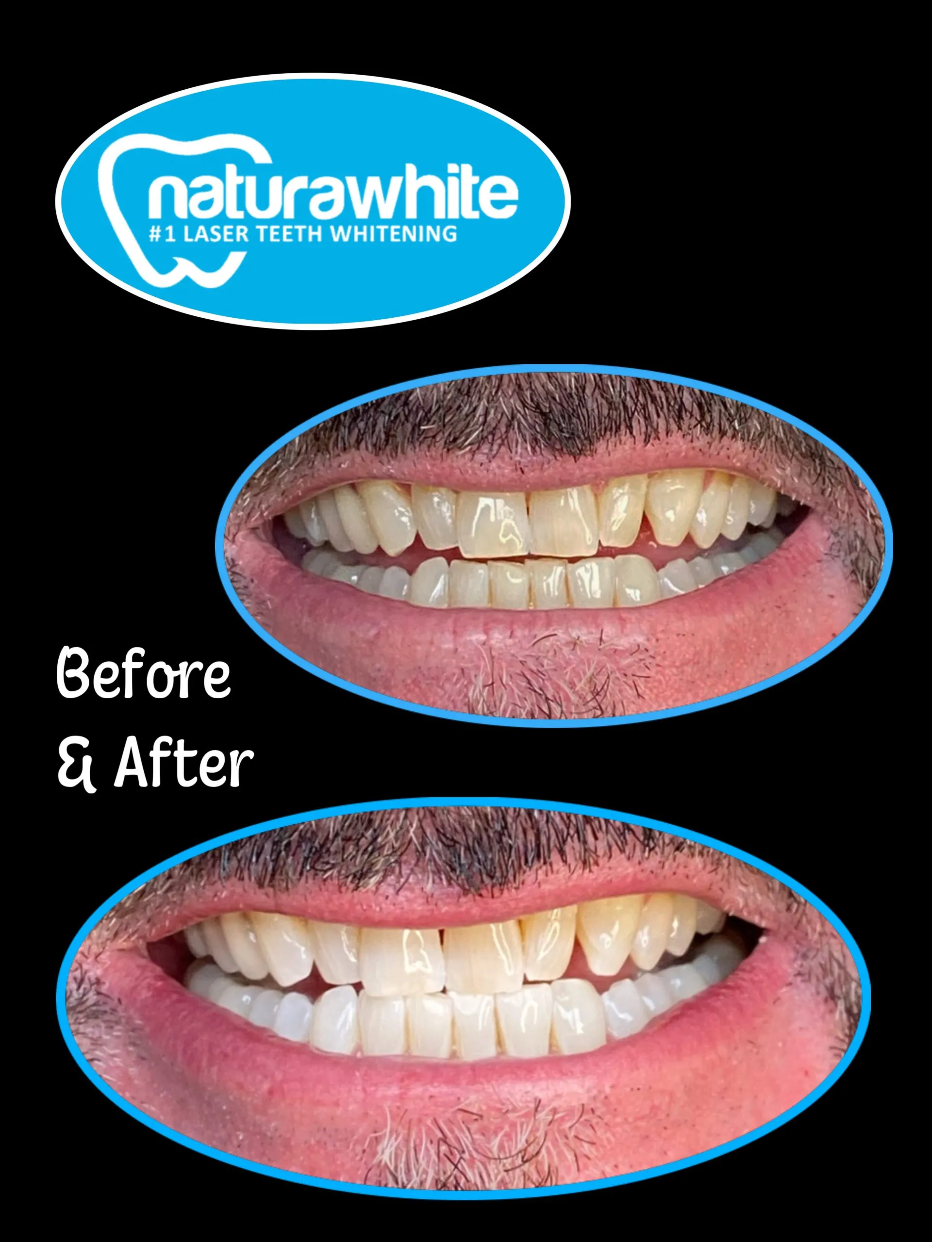26129 pain relief teeth whitening