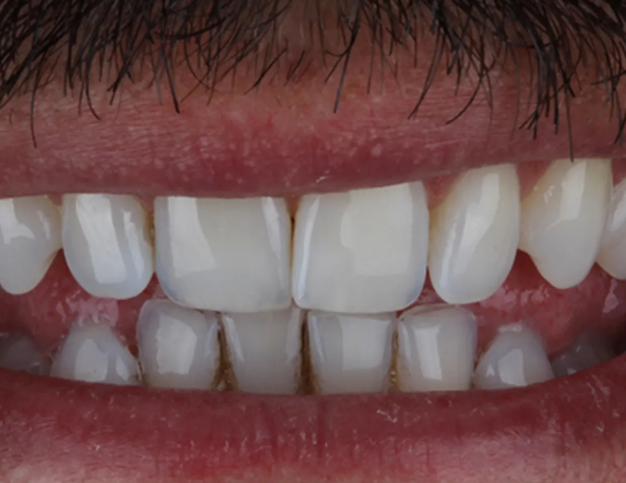 26129 post treatment care
