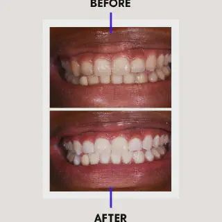 /img/26129-teeth-whitening-options.webp