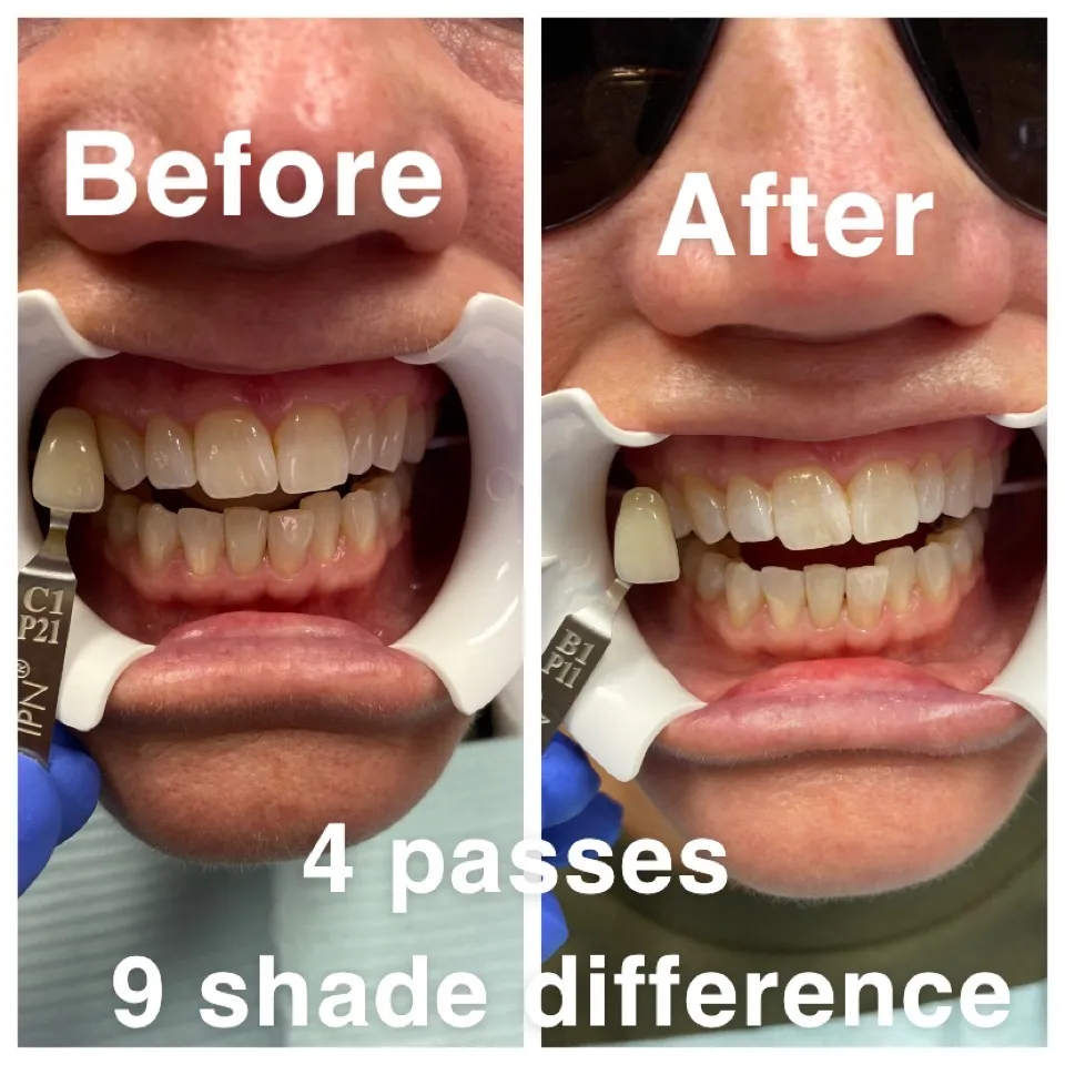26132 florida teeth whitening avoid staining