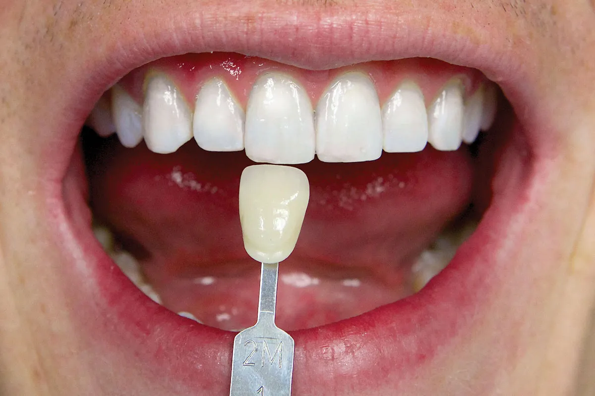26133 zoom teeth whitening houston cost