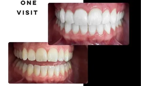/img/26136-teeth-whitening-meridian-id-7.webp