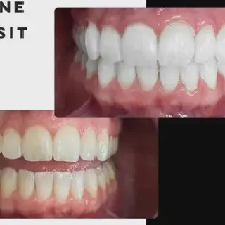 /img/26136-teeth-whitening-meridian-id-7.webp