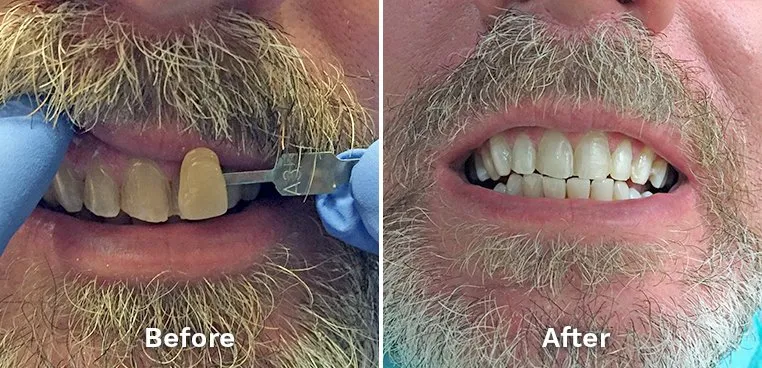 26139 teeth whitening louisville hygiene