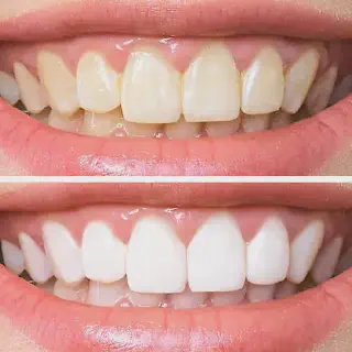 /img/26140-healthy-smile.webp