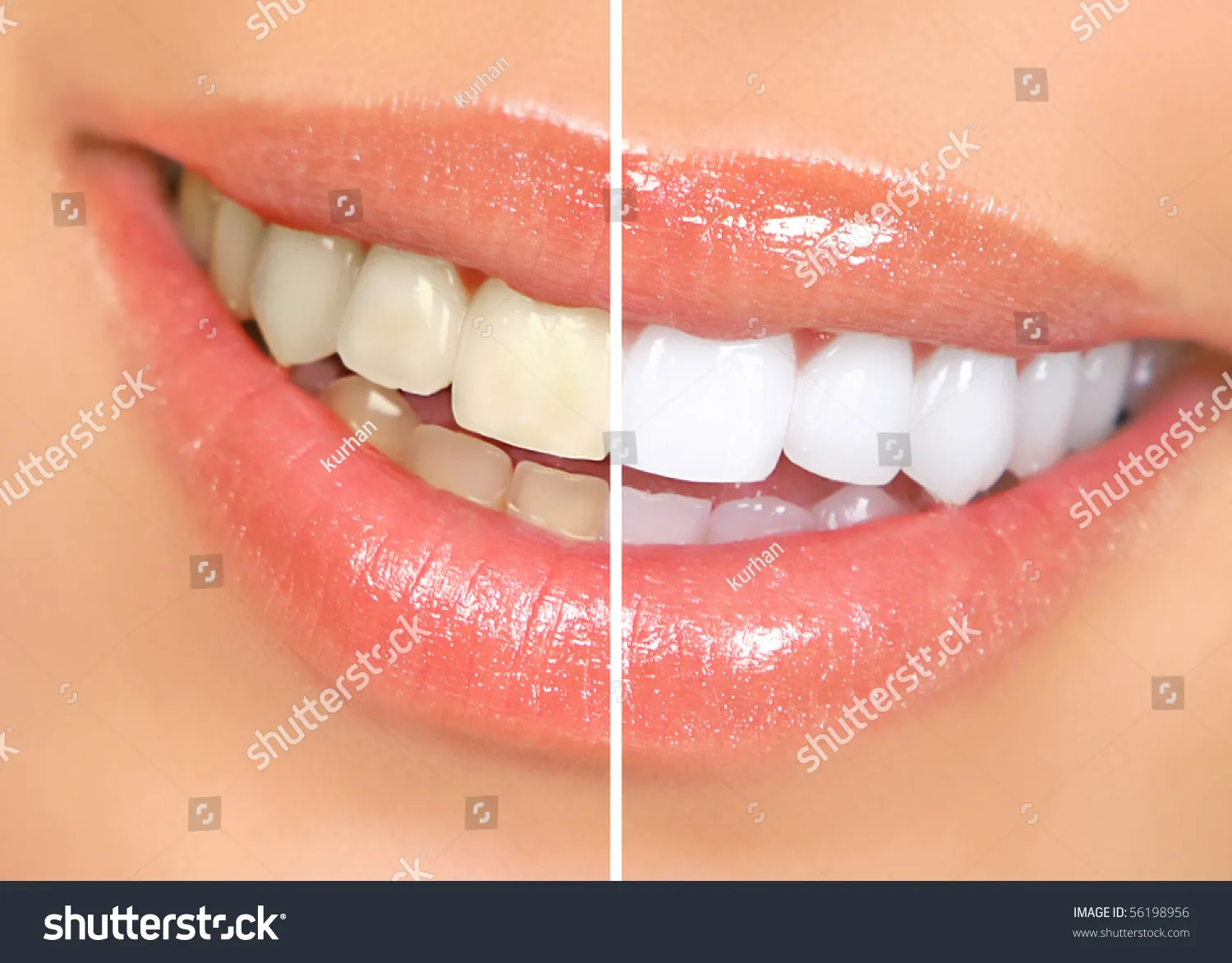 26140 sapphire teeth whitening before and after