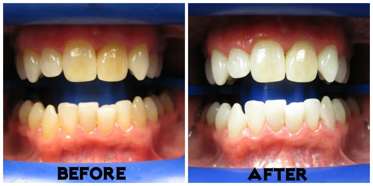 26145 zoom teeth whitening professional care
