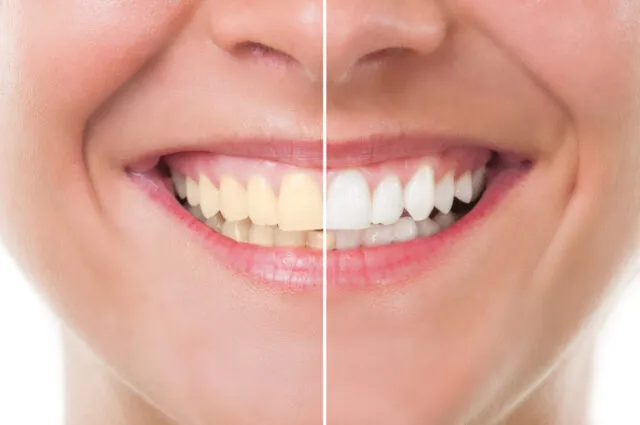 26147 at home teeth whitening