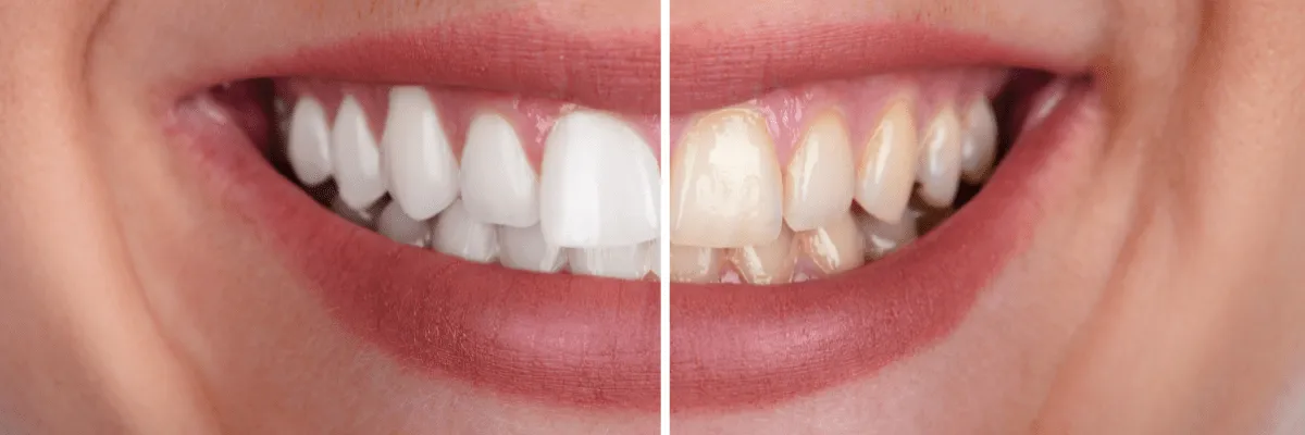 26147 teeth staining
