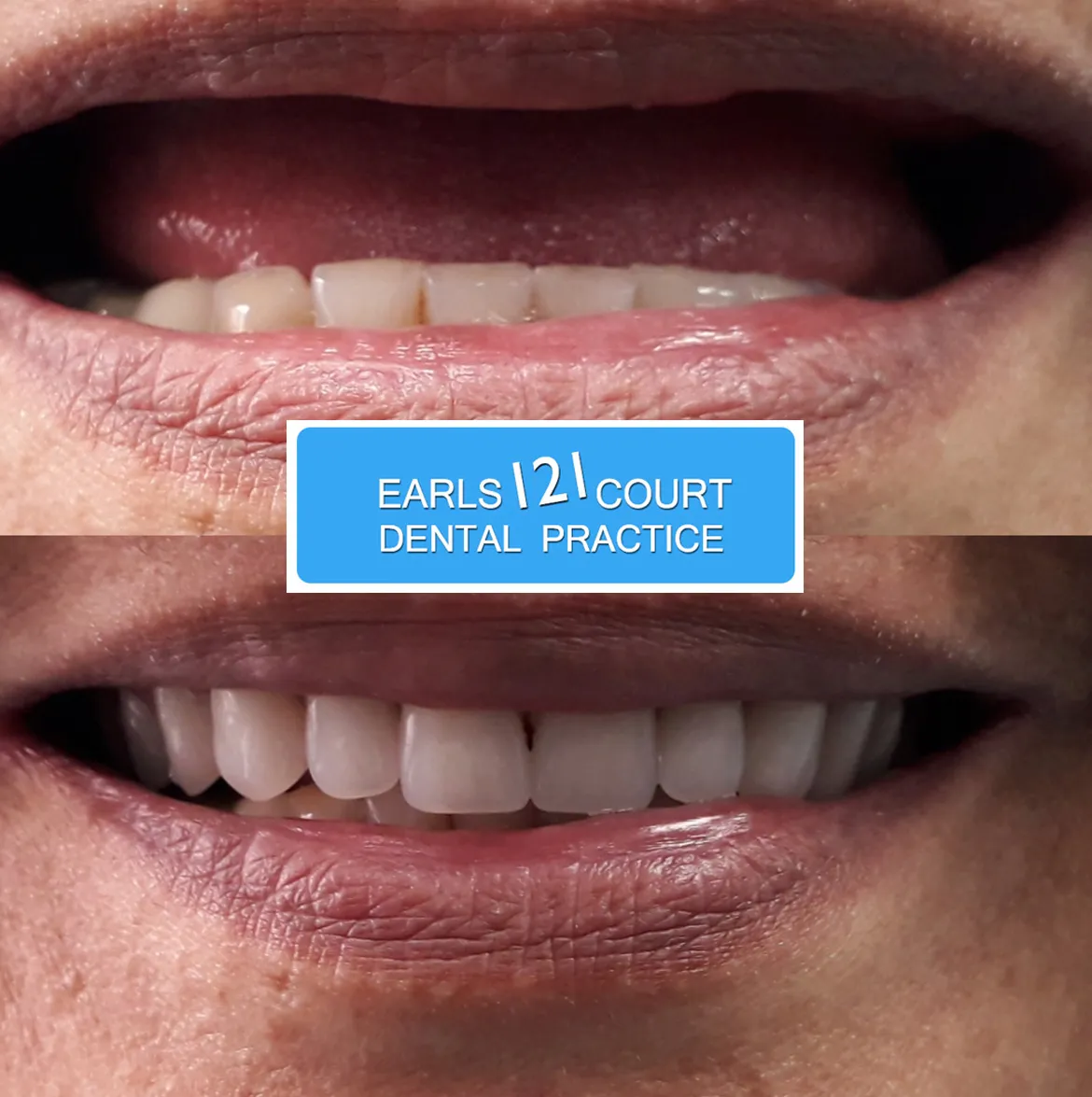26151 teeth whitening results