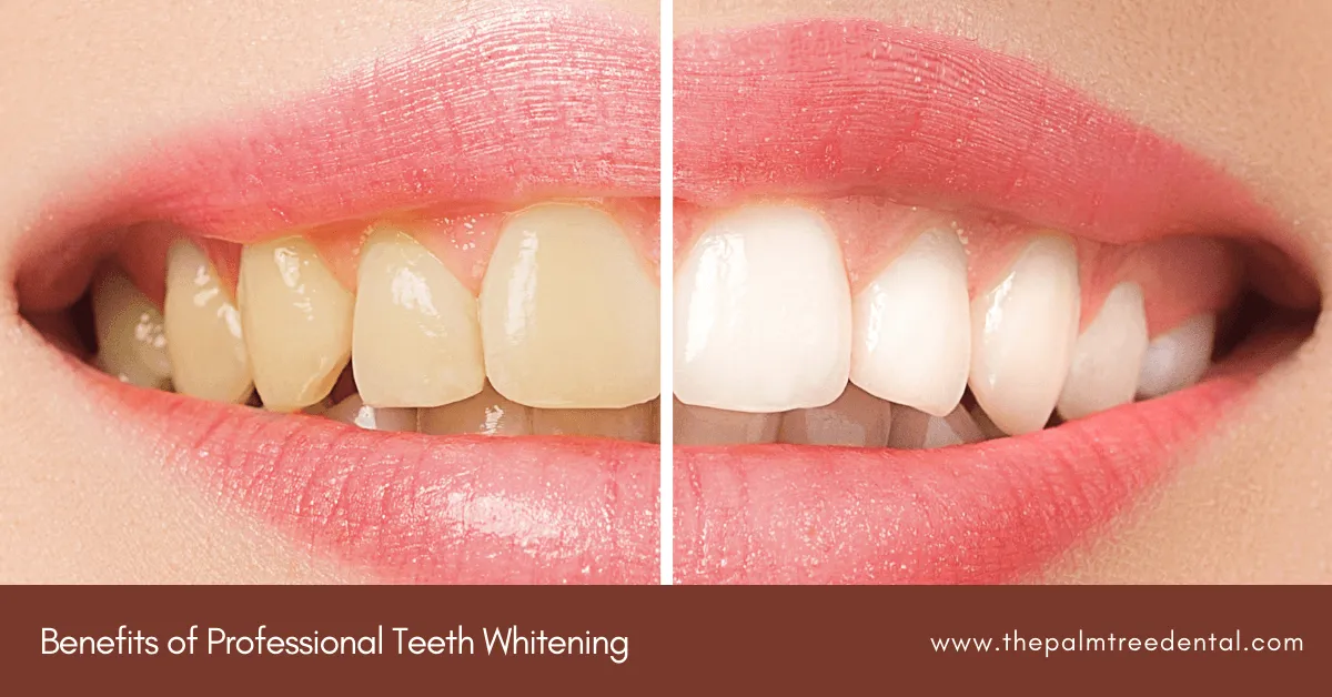26159 teeth whitening aftercare