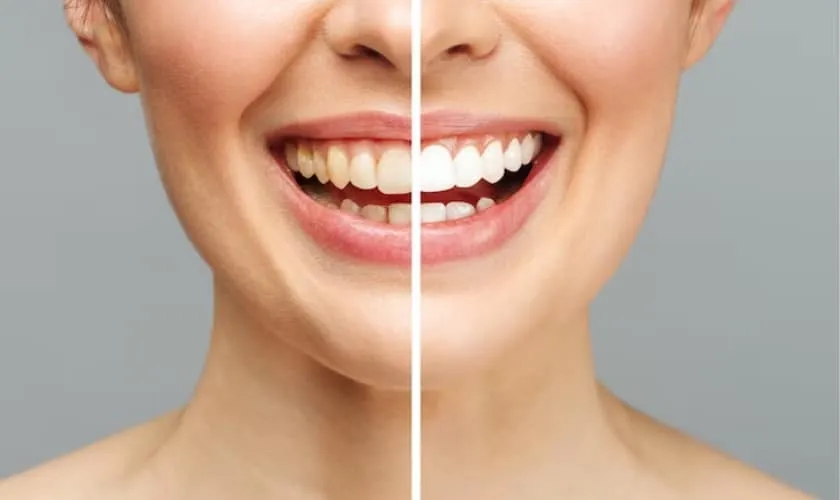 26159 teeth whitening healthy teeth
