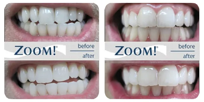 /img/26162-teeth-whitening-aftercare.webp