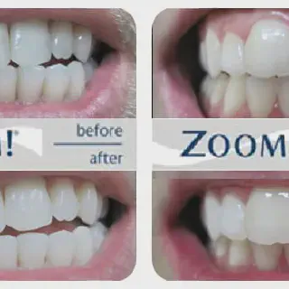 /img/26162-teeth-whitening-aftercare.webp