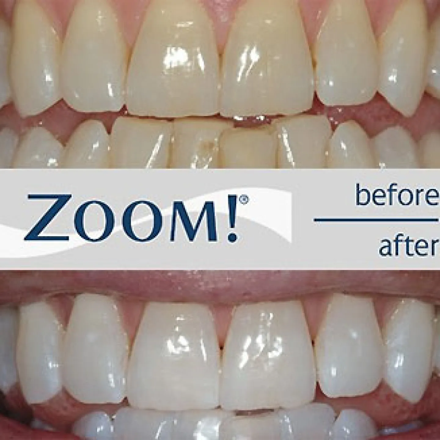 26162 teeth whitening procedure