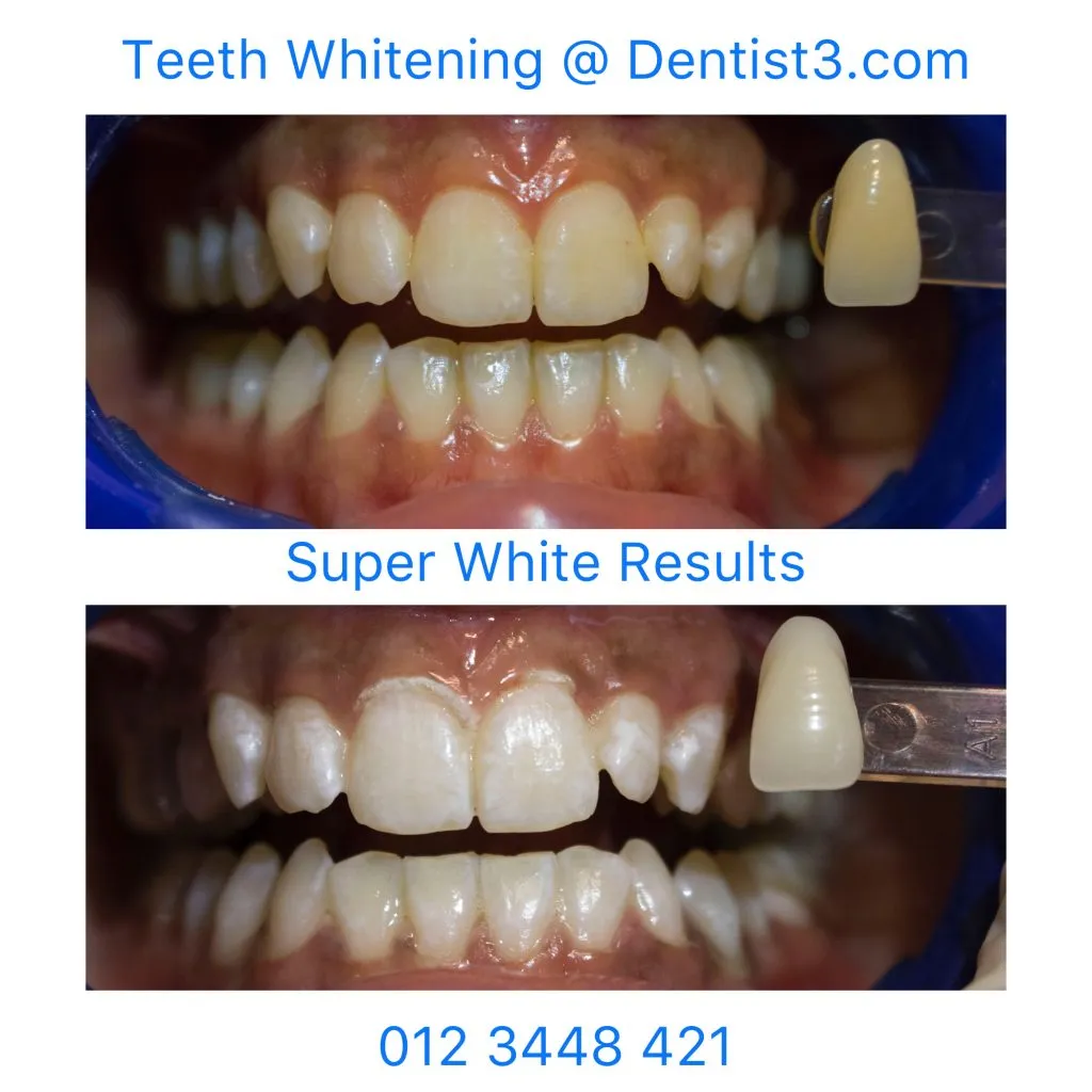 26163 dentist grade whitening before after