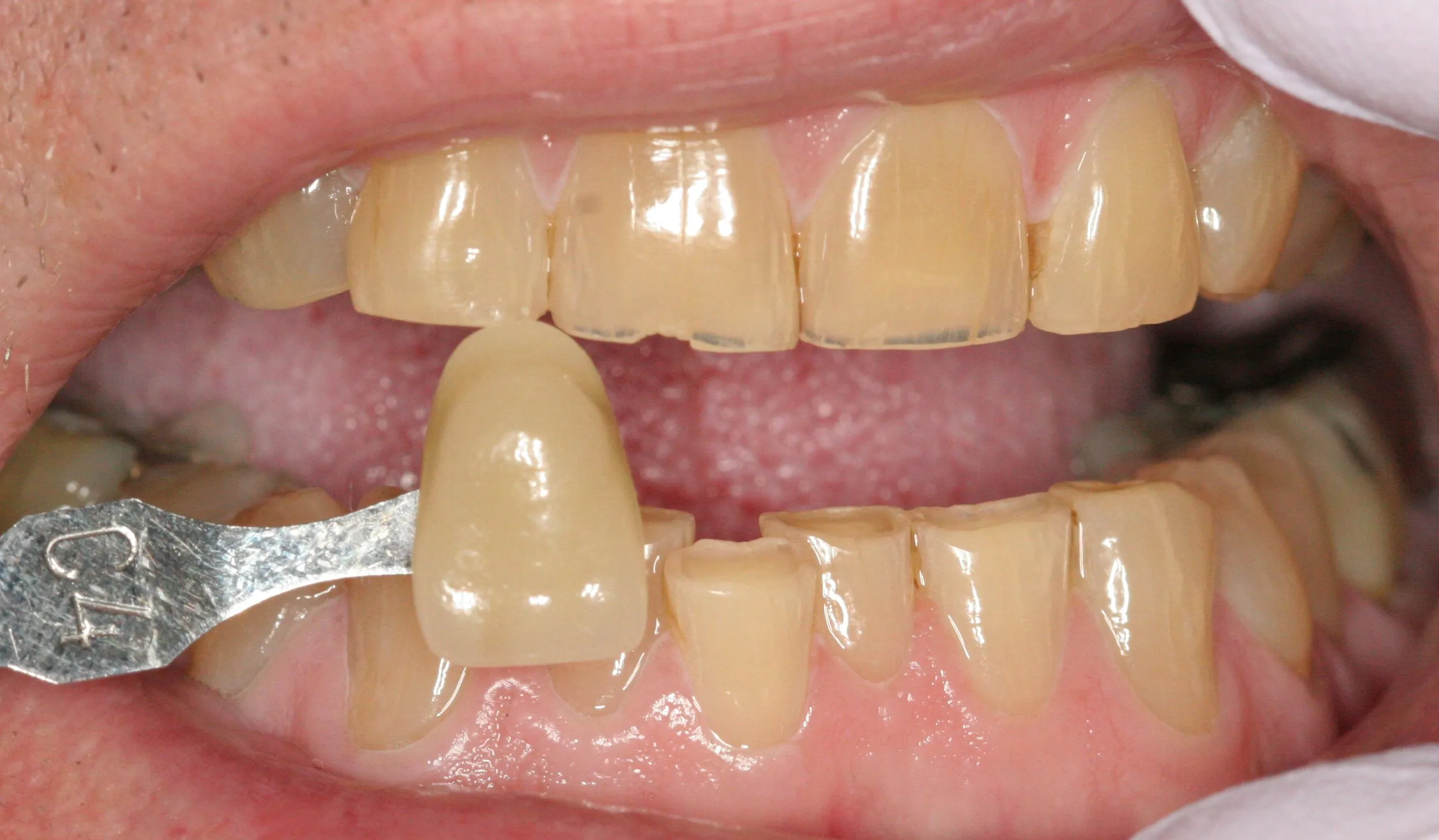 26163 dentist grade whitening consultation