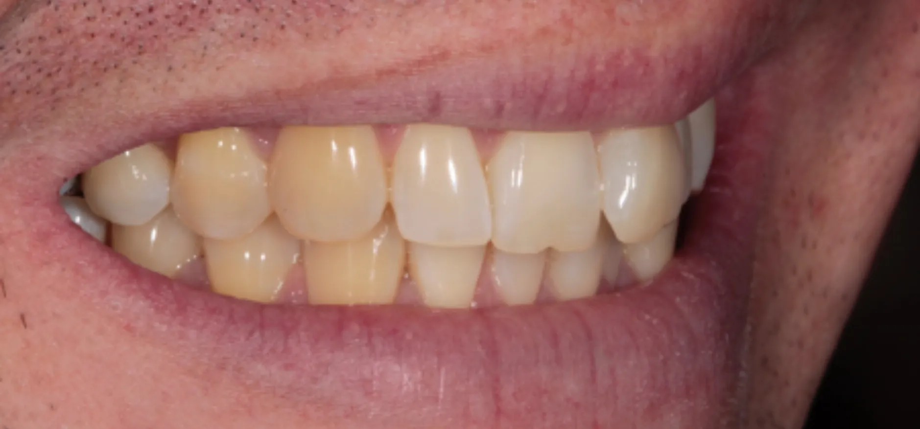 26163 dentist grade whitening sensitivity