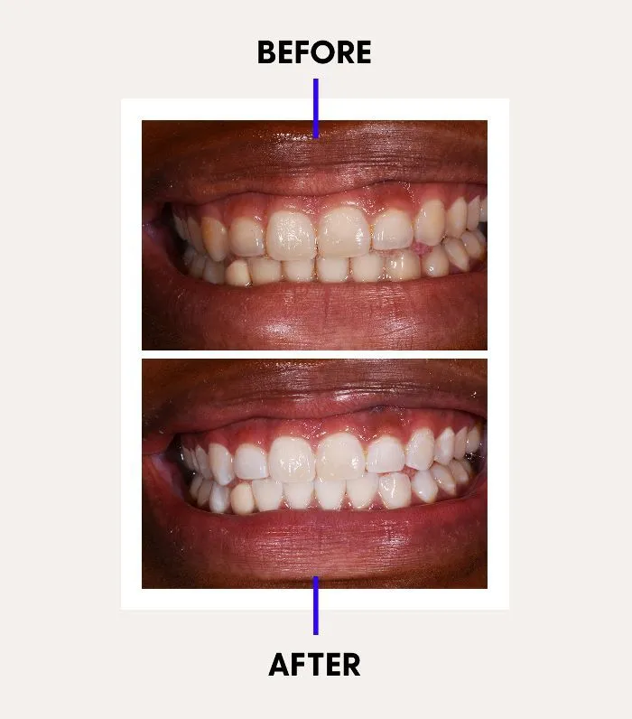 26165 ideal candidate for teeth whitening
