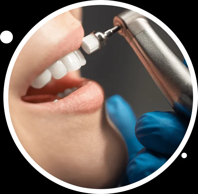 26169 at home teeth whitening kit