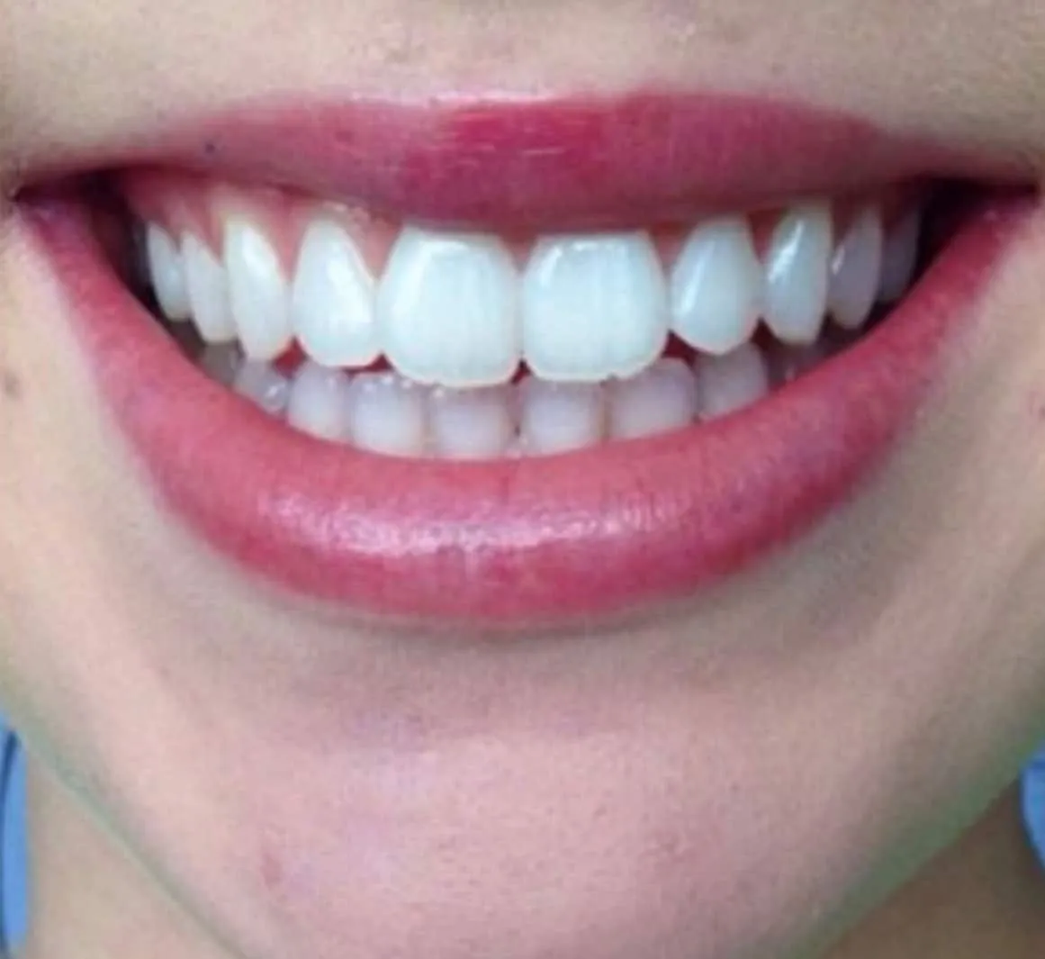/img/26169-teeth-whitening-maintenance.webp