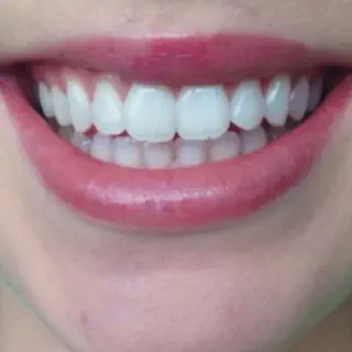 /img/26169-teeth-whitening-maintenance.webp