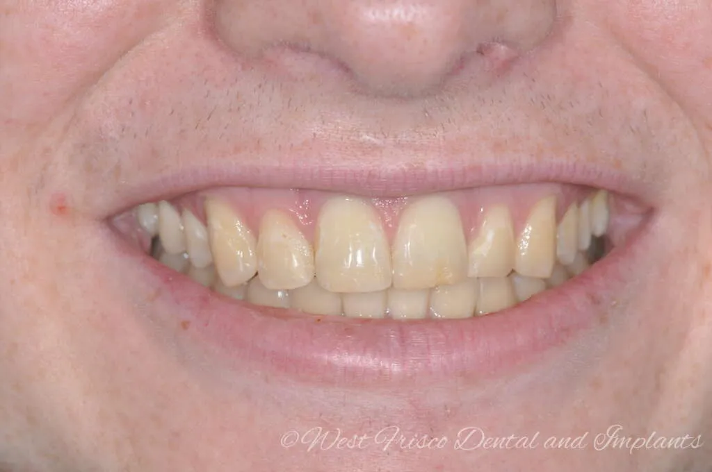 26172 zoom whitening pain 5