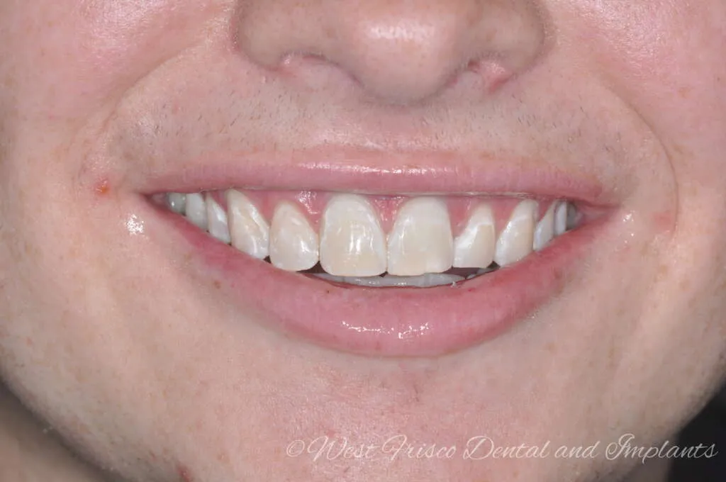 26172 zoom whitening pain 6