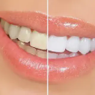 /img/26176-teeth-whitening-dallas.webp