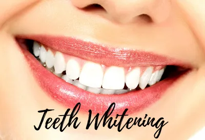 26177 teeth whitening manalapan nj image6