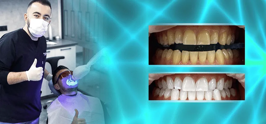 26178 professional teeth whitening