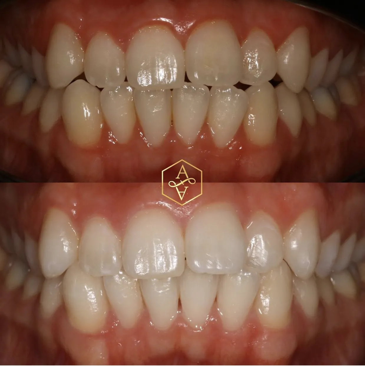 26178 teeth whitening armagh smile