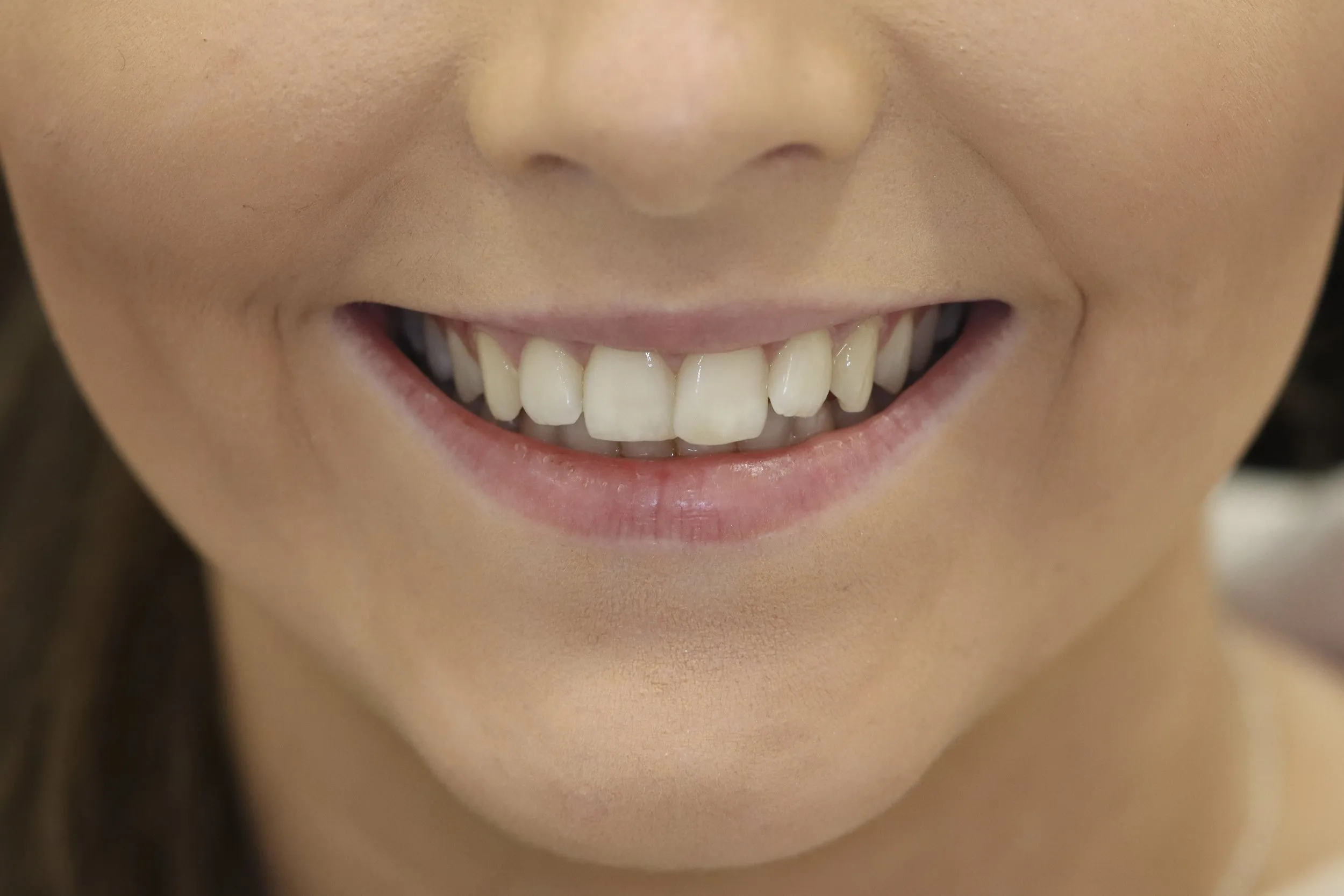 /img/26178-teeth-whitening-confidence.webp
