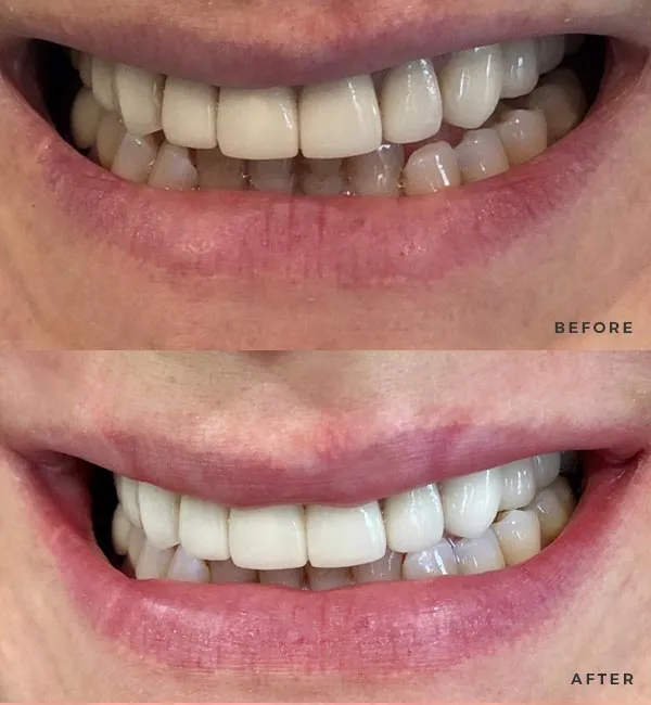 26180 florida labs teeth whitening before after
