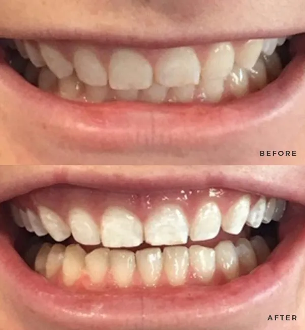 26180 florida labs teeth whitening products