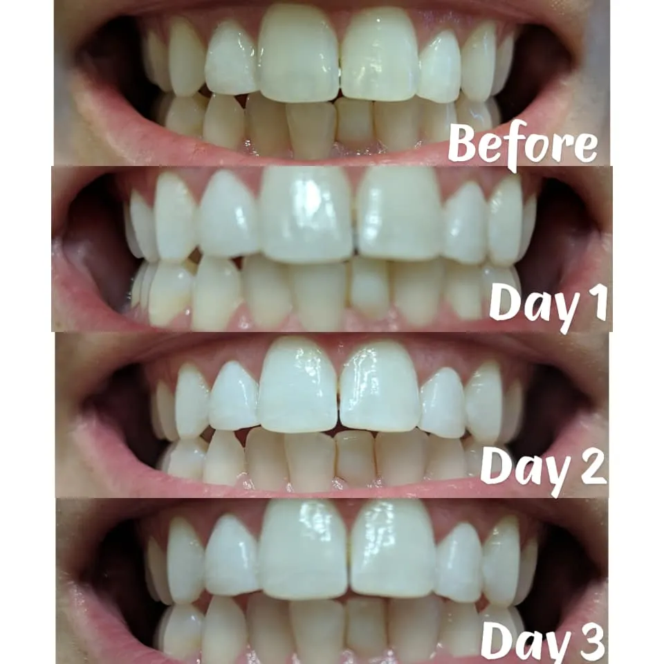 26182 teeth whitening before after