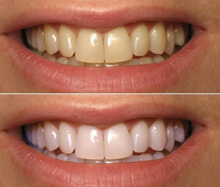 26182 teeth whitening strip ingredients