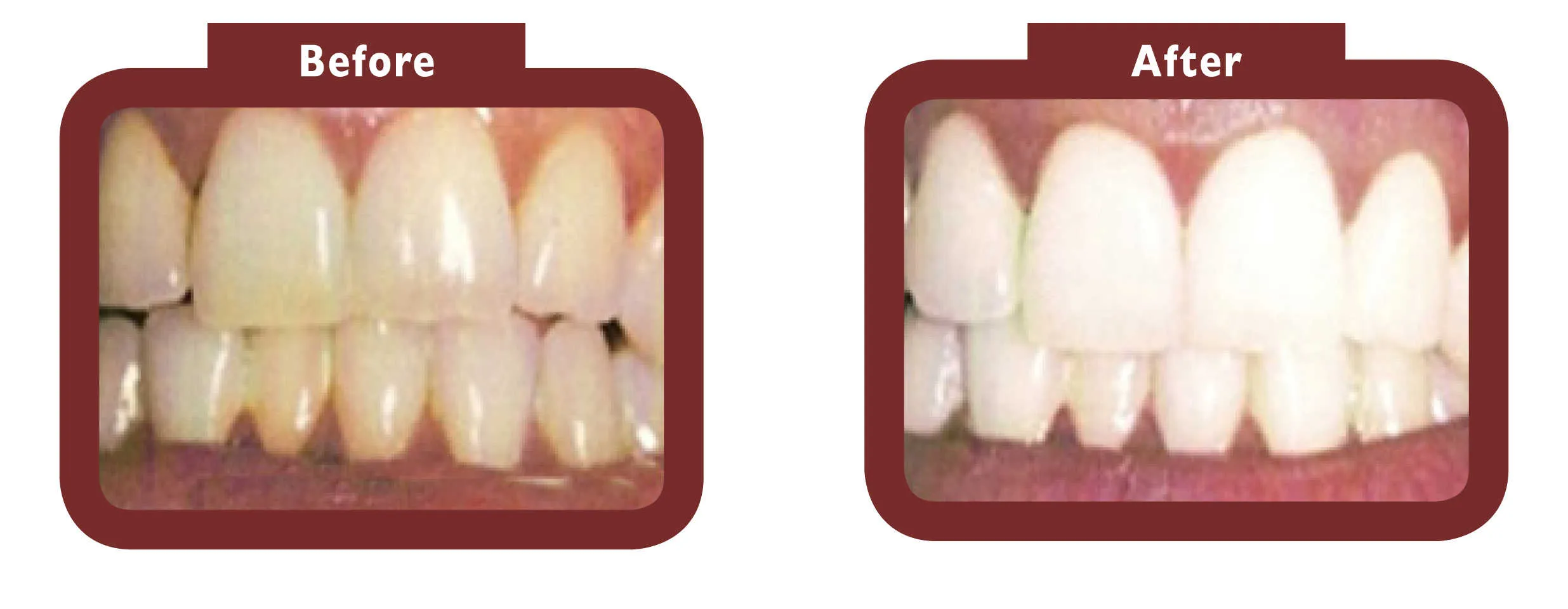 26183 teeth whitening process