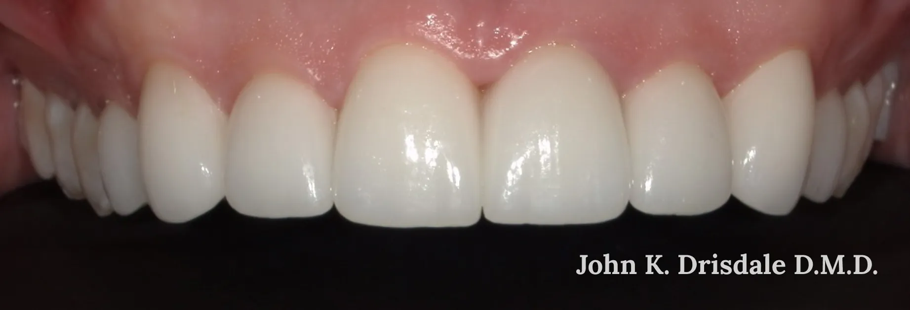 26185 midland teeth whitening in office