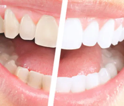 26185 midland teeth whitening sensitive teeth