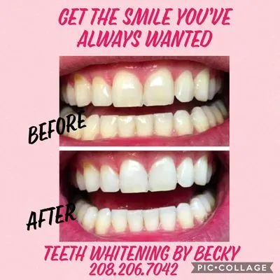 26191 teeth whitening results idaho falls