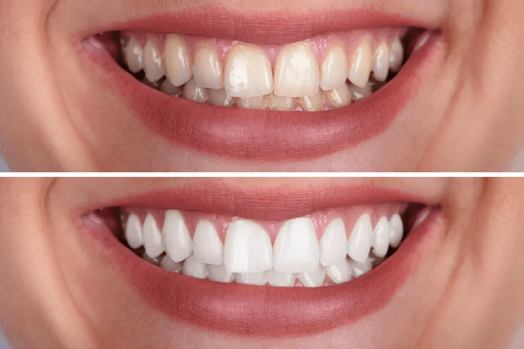 26197 dental whitening before after