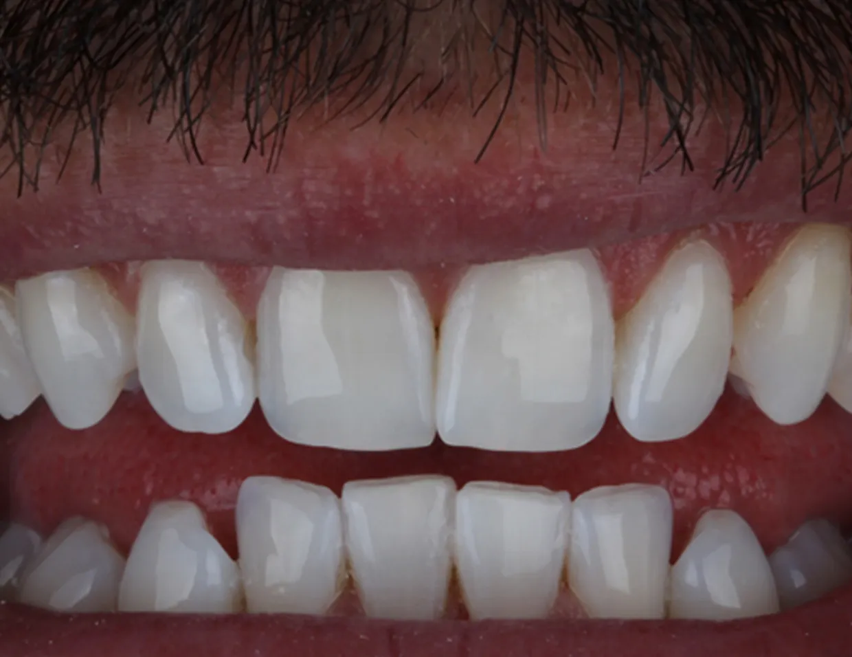 26201 laser teeth whitening risks