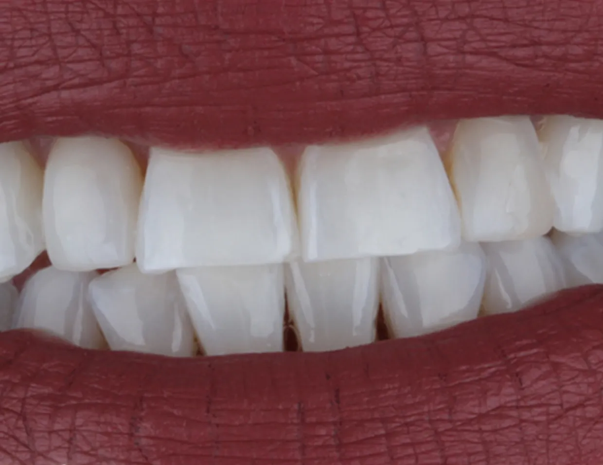 26201 teeth whitening cost