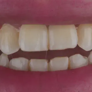 /img/26201-teeth-whitening-maintenance.webp