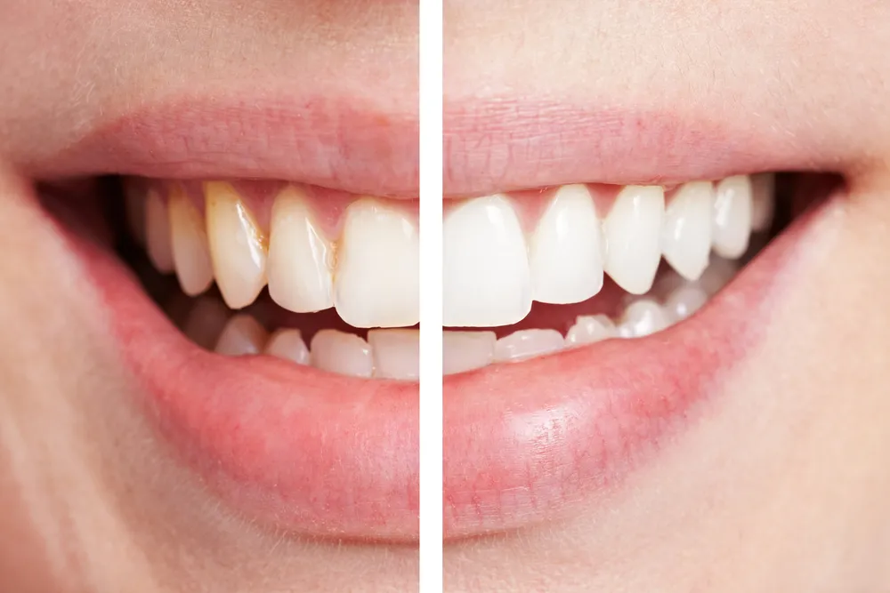 26202 teeth whitening diet