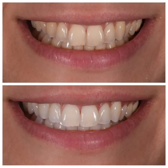 26205 teeth cleaning before whitening